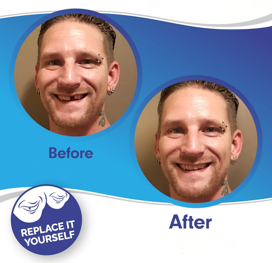 Smile Veneer Set for Upper and Lower Teeth