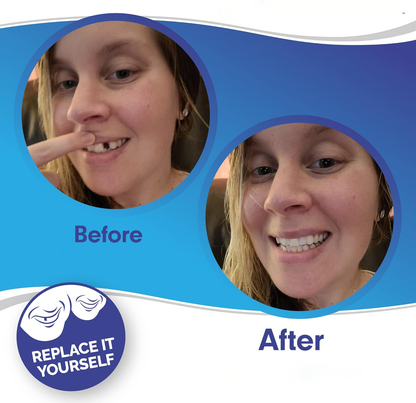 Smile Veneer Set for Upper and Lower Teeth