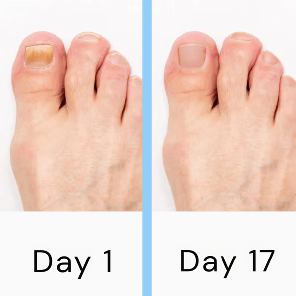 Nail Fungus Laser Treatment Device