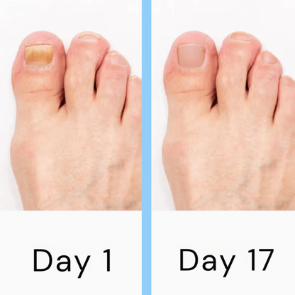 Nail Fungus Laser Treatment Device
