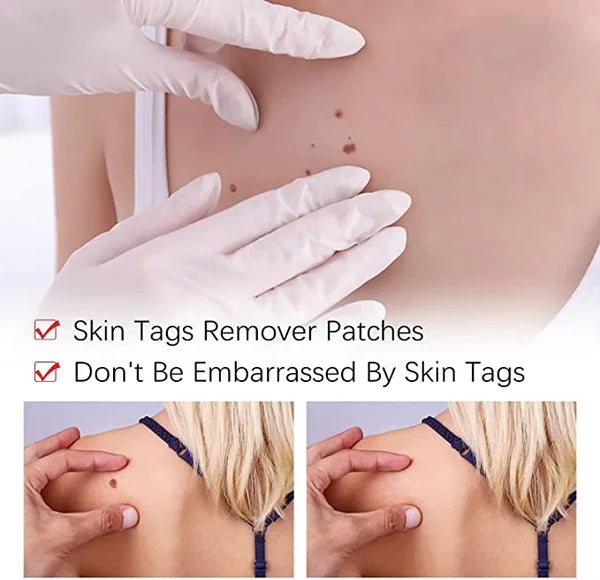 Tags and Moles Remover Tool
