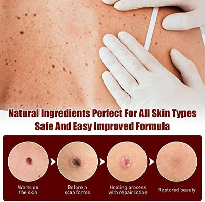Tags and Moles Remover Tool