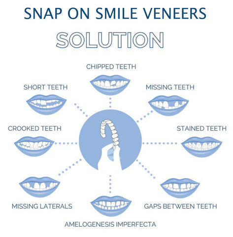 Smile Veneer Set for Upper and Lower Teeth